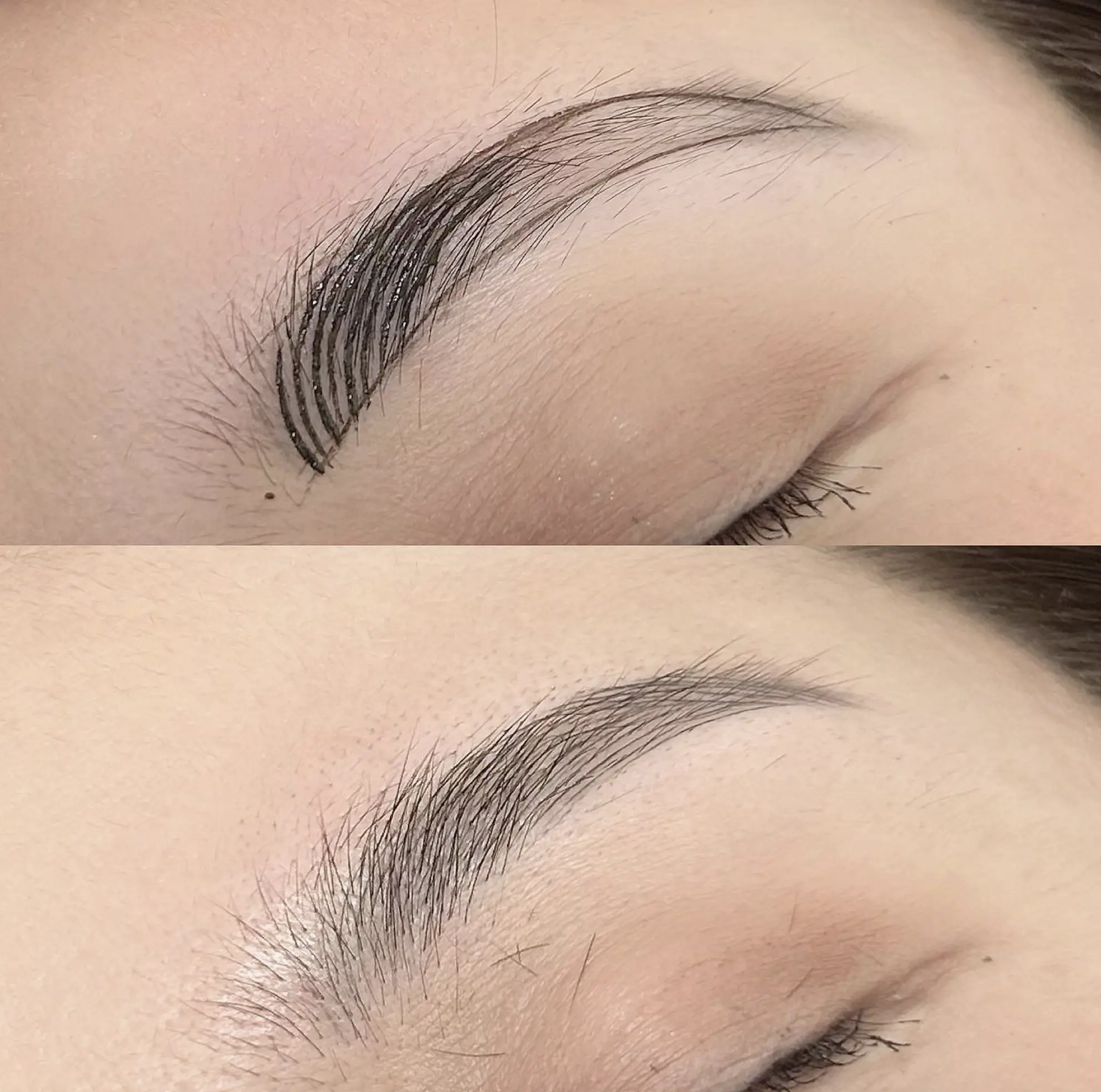 Brow tattoo removal before and after